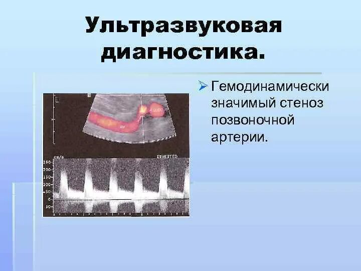 Атеросклероз без гемодинамически значимых стенозов. Гемодинамически значимый стеноз. гемодинамически значимые стенозы артерий. гемодинамически значимые стенозы сосудов значимые. гемодинамически значимый стеноз артерии.