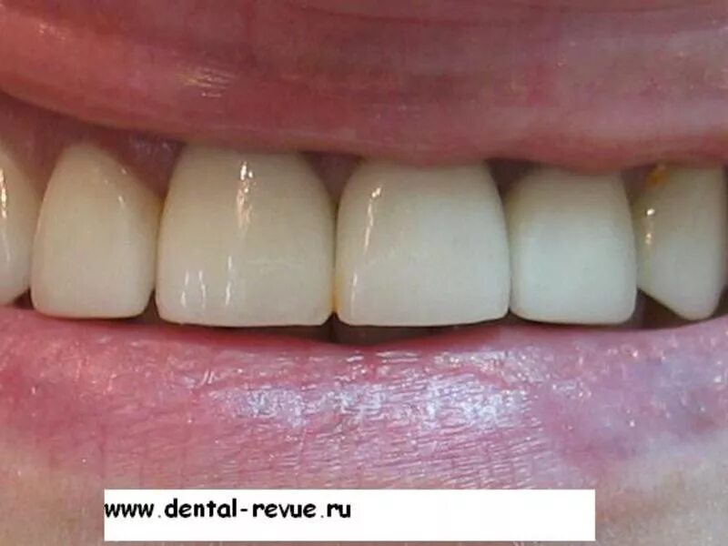коронки на фронтальные зубы
