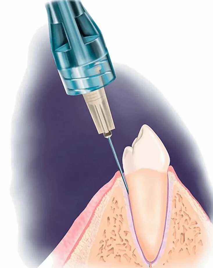 Интралигаментарная анестезия. Внутри котсная анестезия в стоматологии. Интралигаментарная анестезия в стоматологии. Интралигаментарная местная анестезия это. Анестезия полости рта