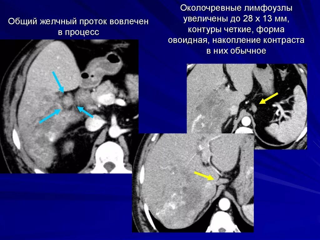 Желчные протоки кт анатомия. Вирсунгов проток на кт норма. Общий желчный проток кт анатомия. Расширение желчных протоков на кт. Увеличенные лимфоузлы в печени