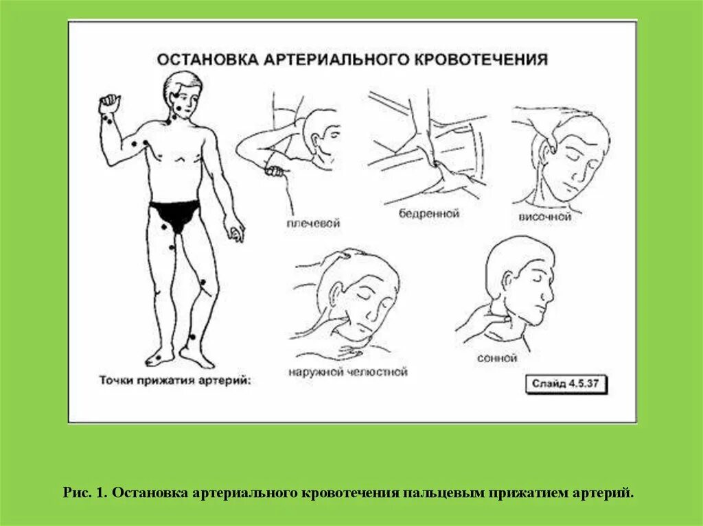 Кровотечение височной артерии. Артериальное кровотечение остановка артериального кровотечения. временные способы остановки артериального кровотечения. артерии для остановки кровотечения.