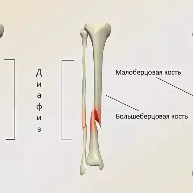 Малоберцовая кость перелом. Перелом диафиза малой берцовой кости. Винтообразный перелом рентген. Перелом большеберцовой кости и малоберцовой кости. Перелом малой берцовой кости.