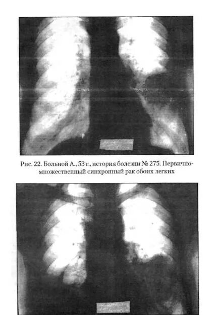 Первично множественные опухоли. Первично множественная опухоль синхронная. Первично-множественная опухоль 1. Первично- множественные опухоли легких. Множественные злокачественные