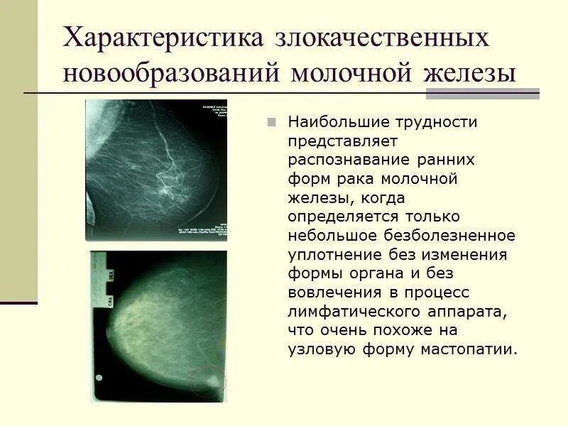 Формы уплотнений в молочной железе. Уплотнение сбоку молочной железы. новообразование молочной железы. злокачественная опухоль молочной железы. доброкачественные новообразования молочной железы.