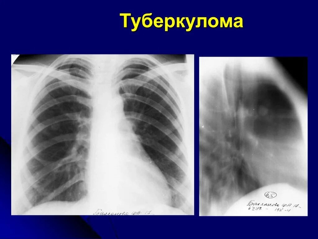 Туберкулома легких рентген. Монетовидное образование в легких. Гиперденсные образования в легких. Образование в легких что это может быть