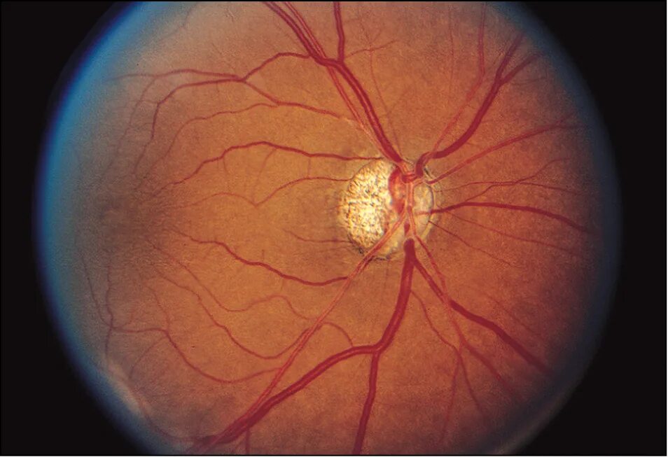 Размеры зрительных нервов. Крупные нервы зрительного нерва. Расположение зрительного нерва. Формирование зрительного нерва.