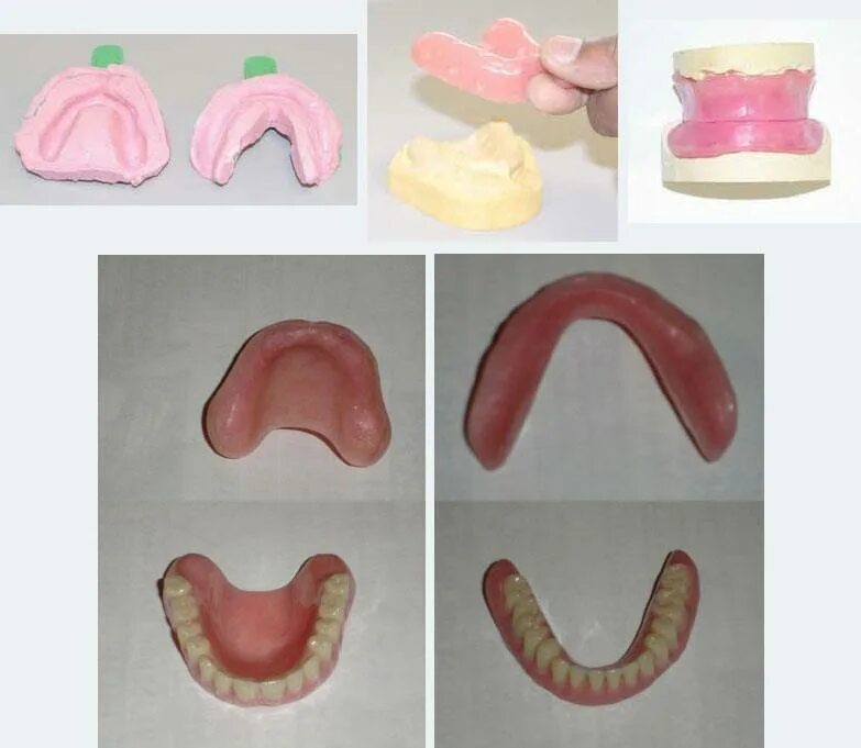 Клинико лабораторные этапы пластиночных протезов. Перебазировка съемного протеза. Пластиночные протезы материалы. Полный съемный пластиночный протез. Частичный съемный пластиночный протез.