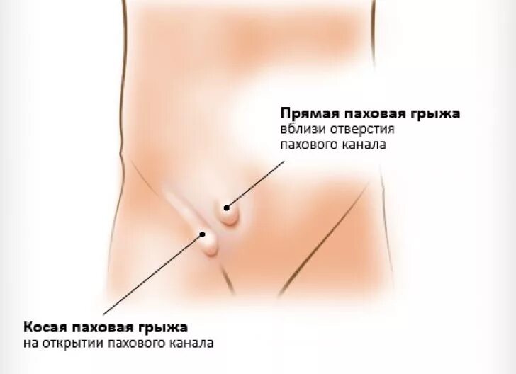 Косая паховая грыжа у ребенка. Косая и прямая паховая грыжа. Левосторонняя косая паховая грыжа. Паховая грыжа у мальчика 5 лет. Прямая и косая паховые грыжи