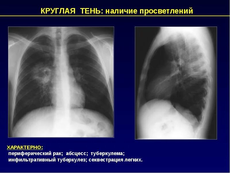 Инфильтративный туберкулез рентгенологический синдром. Инфильтративный туберкулез синдромы рентген. Туберкулез туберкулема. Туберкулема рентгенологический синдром. Рентгенологические синдромы легких