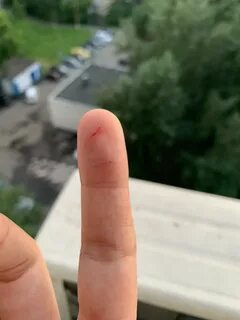 Палец без подушечки