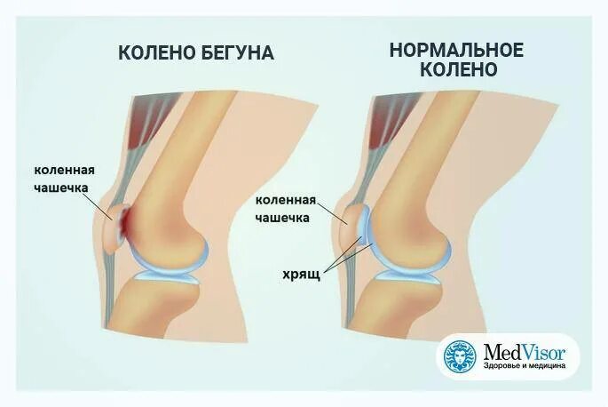 Почему щелкают ноги. Щелчки в коленном суставе при приседании.