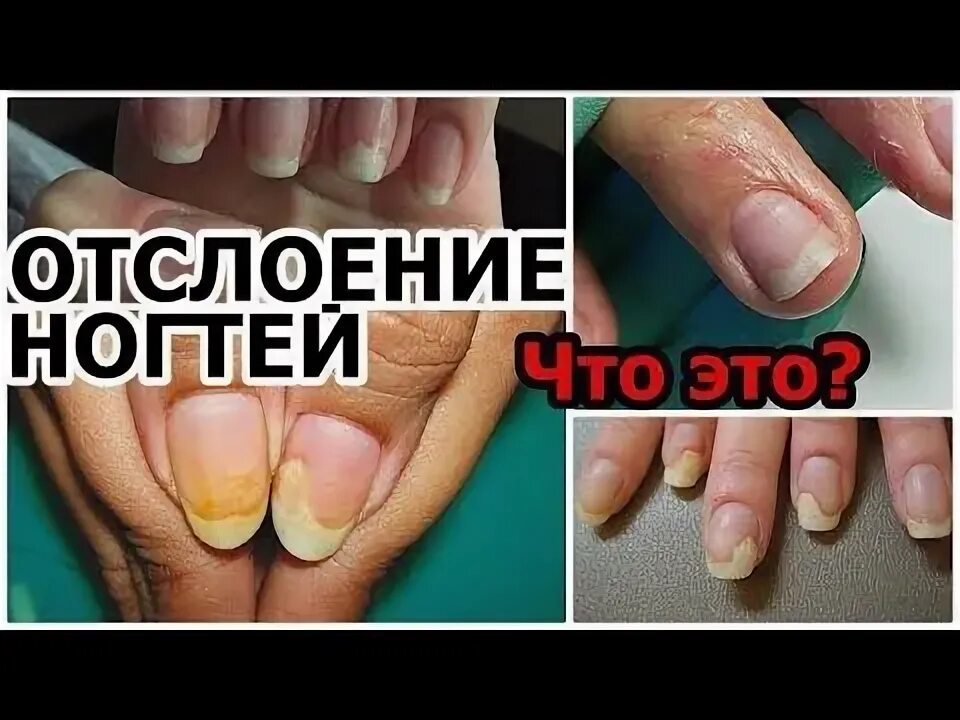 Онихолизис (отслоение ногтей): врачи объясняют, что делать. - YouTube