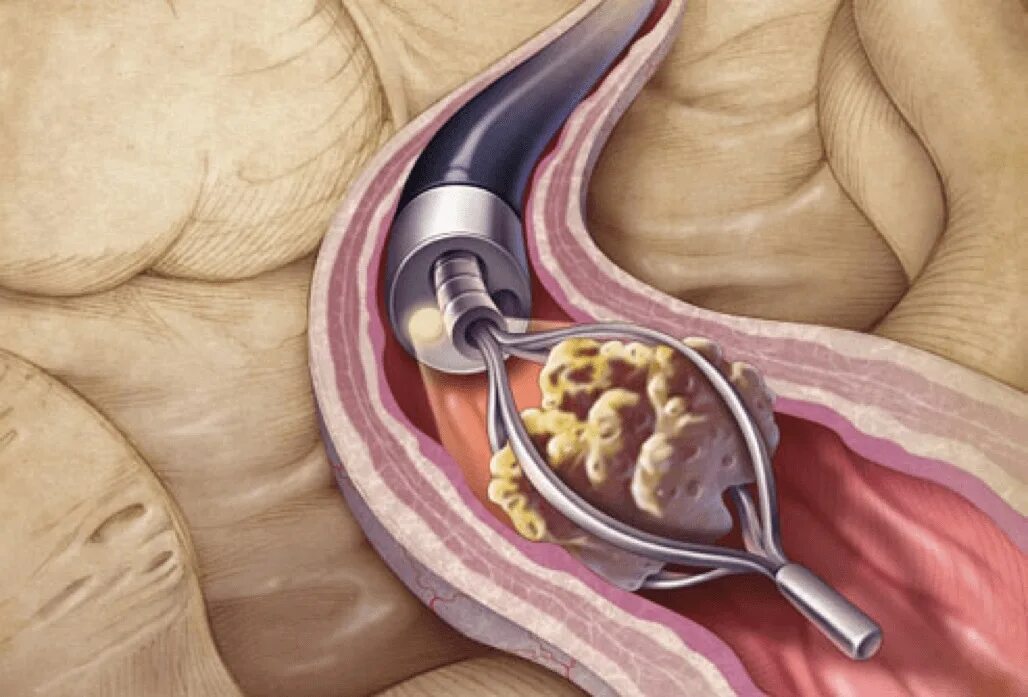 Удаление камня через проток. Трансуретральная уретеролитоэкстракция. Литотрипсия камней почек. Эндоскопическая контактная литотрипсия. Трансуретральная эндоскопическая уретеролитотрипсия.