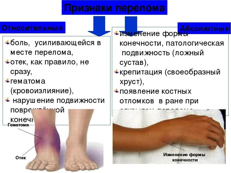 Что делает кости сильными. Переломы нижних конечностей. Признаки перелома конечности.