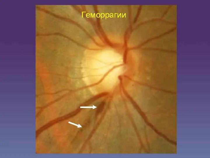 Зрительный нерв при глаукоме. Глаукомная оптическая нейропатия зрительного нерва. Геморрагии на ДЗН при глаукоме.