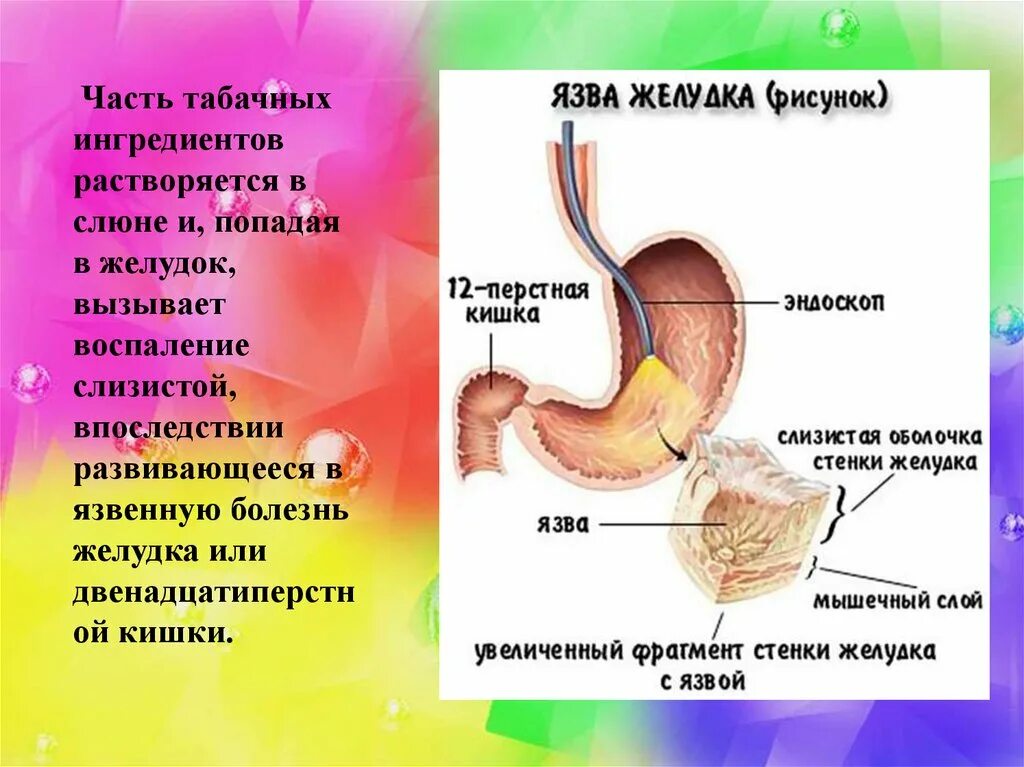 Профилактика язвы желудка. Желудок рисунок. Вредные привычки желудка. Язвенная болезнь желудка и двенадцатиперстной кишки. Крови и боли в желудке