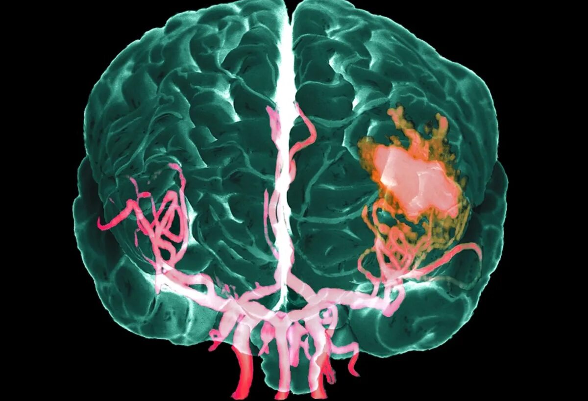 Brain 140. Сосуды головного мозга кровоизлияние. Аномалии сосудов головного мозга.