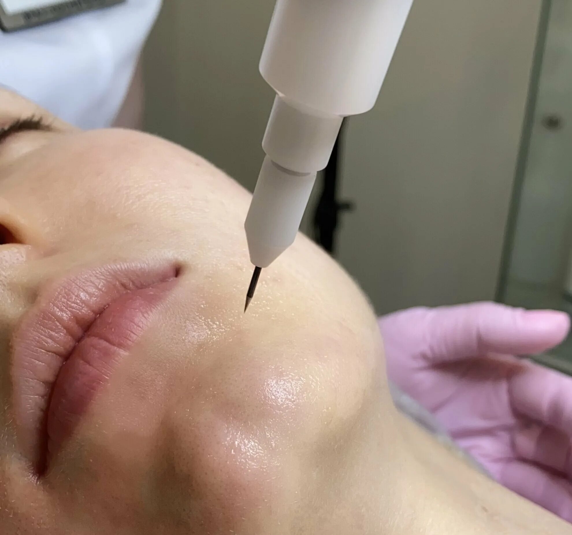 Плазма процедура. Плазма процедура. Плазмотерапия плазмолифтинг косметология. Плазма процедура. Плазма процедура.