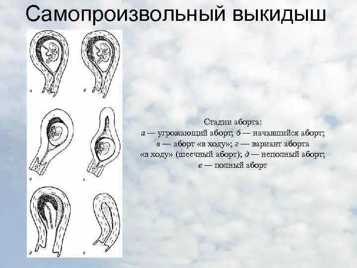 Самопроизвольный аборт. Угрожающий самопроизвольный выкидыш. Самопроизвольный выкидыш этапы. Стадии самопроизвольного выкидыша.