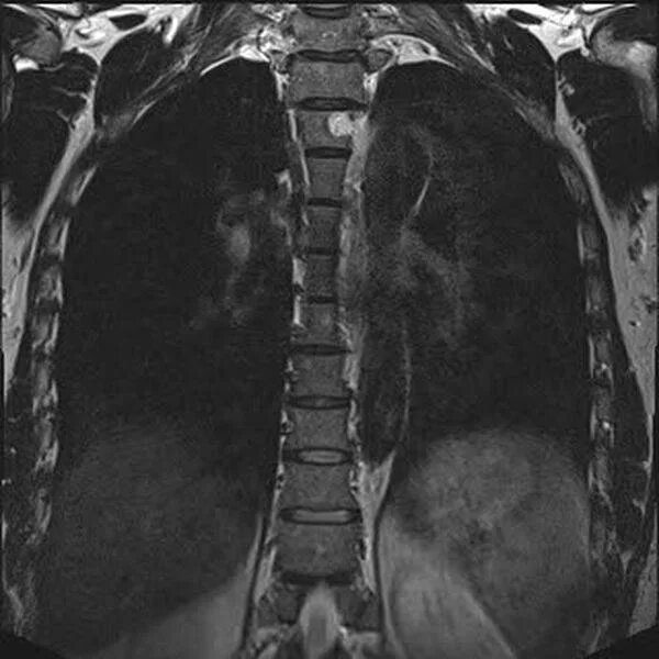Гемангиома позвоночника мрт. Гемангиомы на снимке мрт позвоночника. Гемангиома позвоночника поясничного отдела мрт. Мрт грудного отдела.