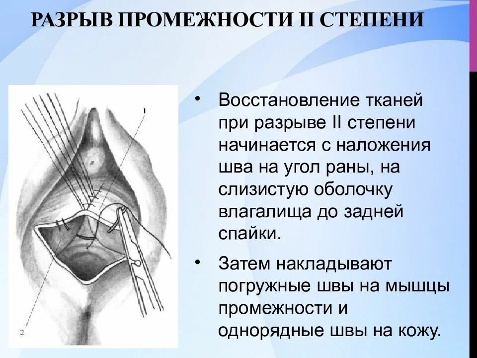 Разрыв задней спайки влагалища. Разрыв промежности II степени. Степени разрыва промежности. Три степени разрыва промежности.