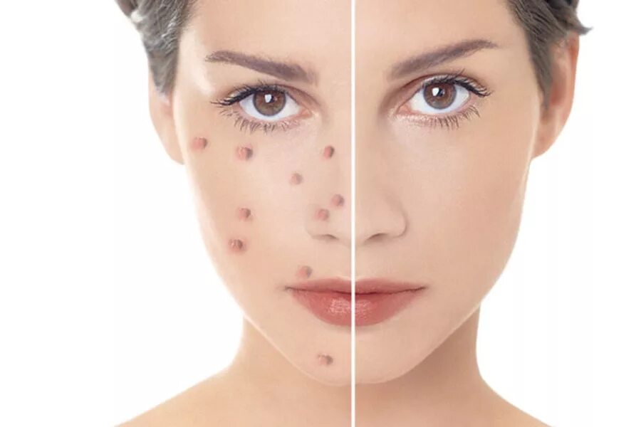 Acne program