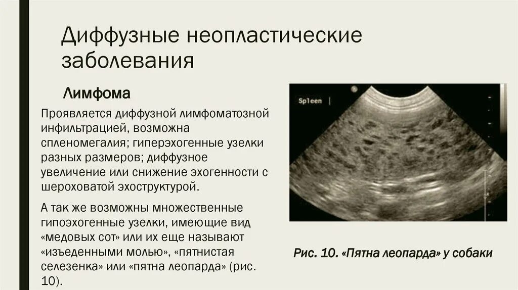 Диффузно инфильтративная. Лимфома Ходжкина селезенка.