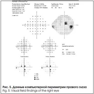 Компьютерная периметрия что это такое