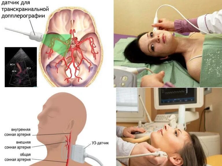 Ультразвуковая допплерография магистральных артерий головы и шеи. Допплеровское сканирование сосудов головы и шеи. УЗДГ сосудов головы и шеи брахиоцефальных сосудов. Ультразвуковое дуплексное сканирование брахиоцефальных артерий. Бцс что это за обследование