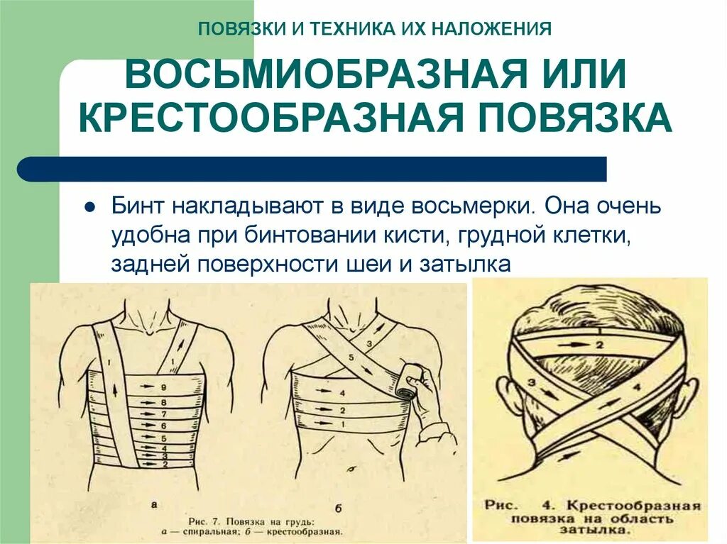 Крестообразная повязка. Крестообразная (восьмиобразная) повязка. Крестообразная повязка на спину. Восьмиобразная повязка на грудь. Крестообразная повязка на грудь.