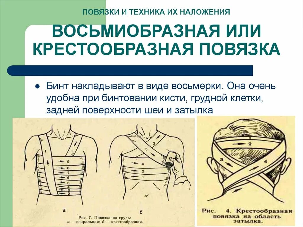 Повязка манипуляция. Крестообразная (восьмиобразная) повязка. Типы повязок восьмиобразная. Крестообразная бинтовая повязка. Бинтовые повязки: • крестообразная (восьмиобразная.