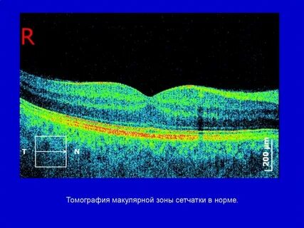 Томография сетчатки