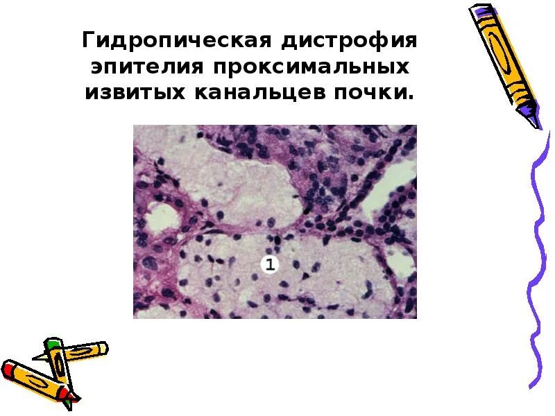 Гидропическая дистрофия эпителия извитых канальцев почки. Паренхиматозная гидропическая дистрофия. Гидропическая дистрофия гепатоцитов гистология. Гидропическая дистрофия патанатомия.