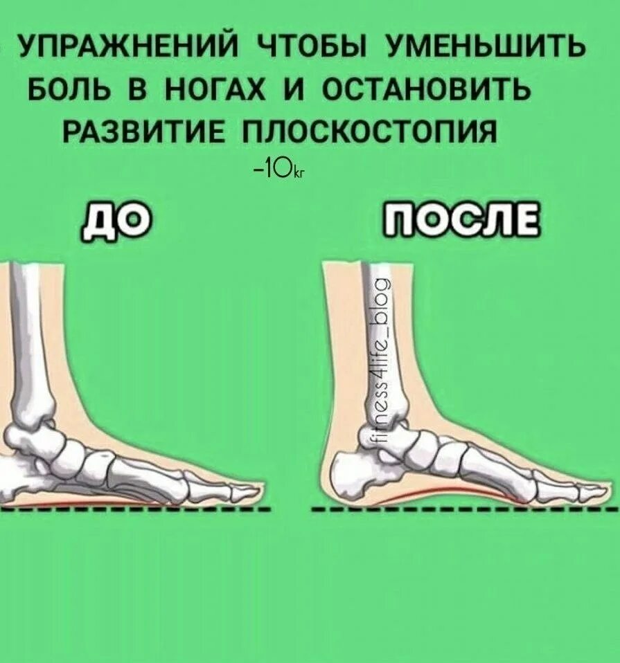 Почему сжимает ноги. Плоскостопие. Стопа плоскостопие. Боли в ногах при плоскостопии. Болят стопы при плоскостопии.