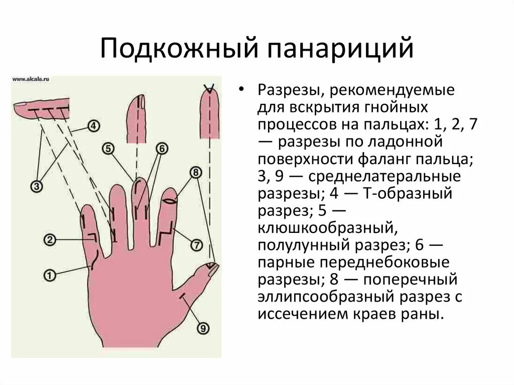 Сухожильный панариций 1 пальца. Разрезы при суставном панариции. Подкожный панариций клюшкообразный разрез. Кожный панариций кисти.