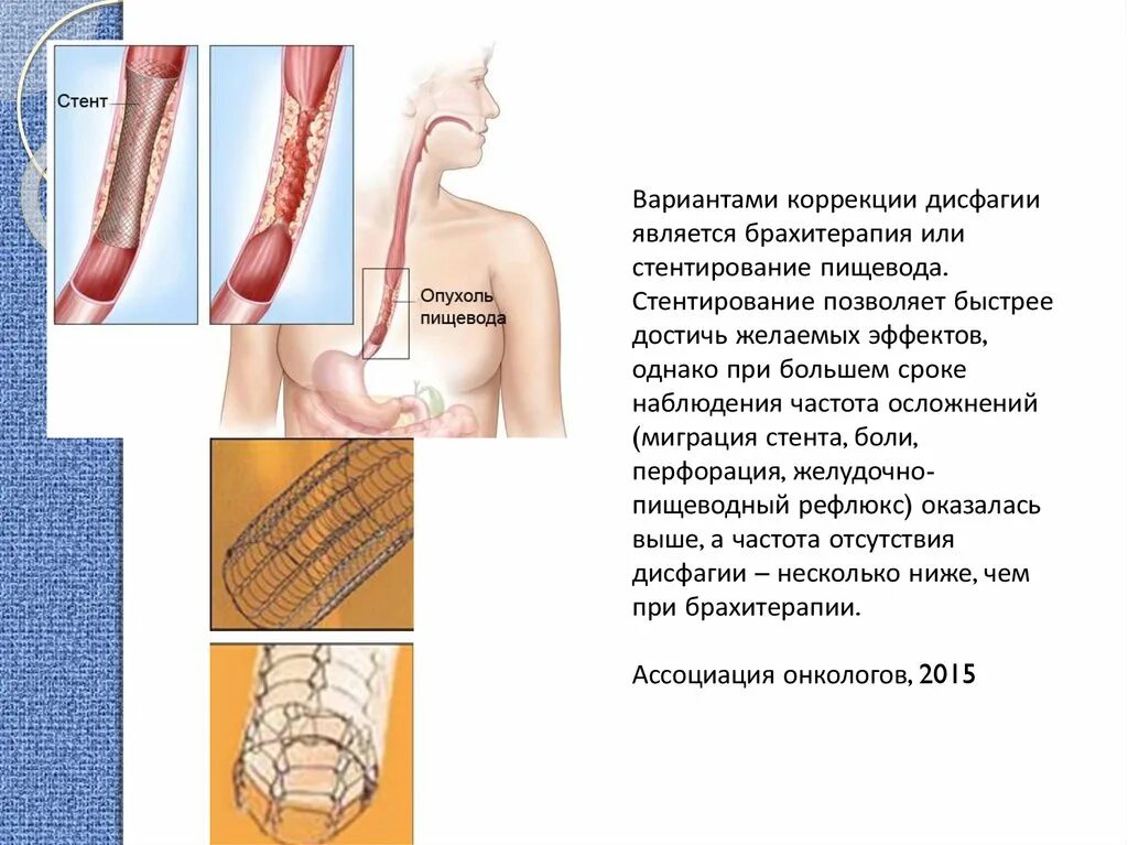 Стентирование пищевода. Методика стентирования пищевода. Стенты отзывы