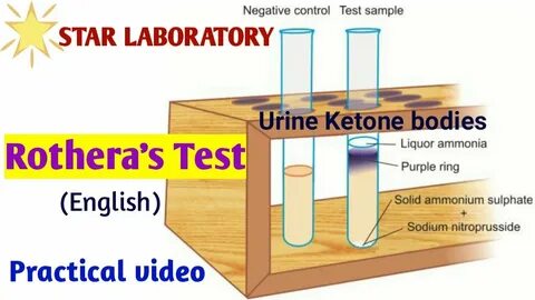Rothera's test/urine ketone test procedure/urine ketone bodies test procedure/Ur