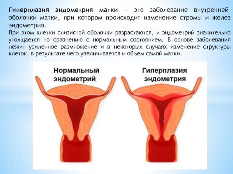 Увеличена эндометрия матки. Эндометрическая гиперплазия. Гиперплазия эндометрия матки что это. Патология эндометрия гиперплазия эндометрия. Эндометрий матки гиперплазия.