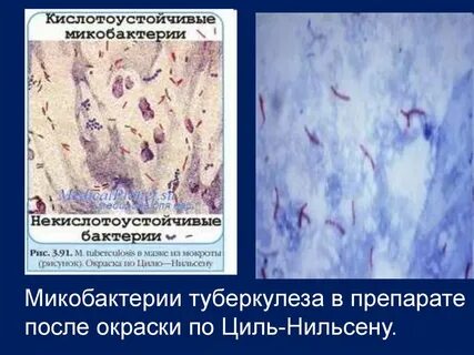 Метод окраски кислотоустойчивых бактерий