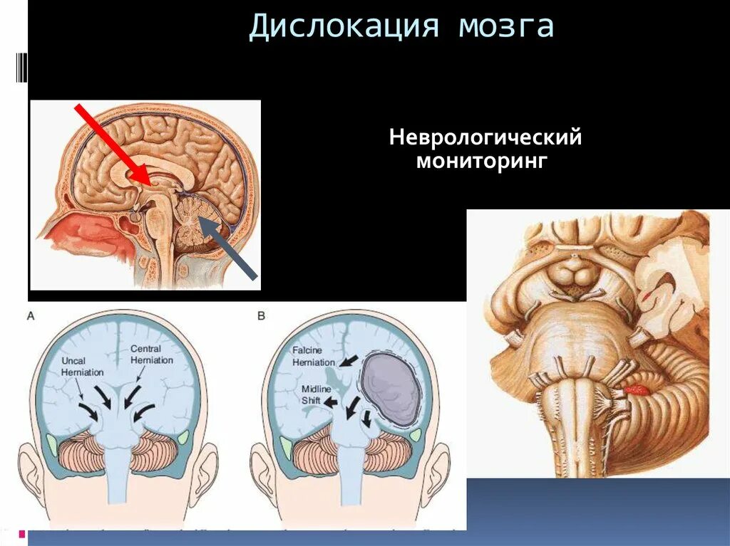 Неспецифические изменения мозга. Дислокация ствола головного мозга. Вклинение ствола головного мозга. Латеральная дислокация срединных структур мозга. Аксиальная дислокация головного мозга.