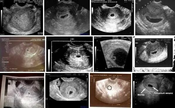 Снимок УЗИ 2-3 недели беременности. УЗИ 1 неделя беременности. Беременность 1 неделя после зачатия УЗИ. УЗИ беременности на ранних сроках 1 неделя после зачатия. Узи 1 2 недели беременности