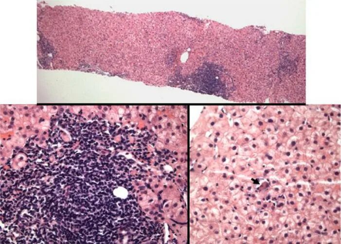 Лекарственный гепатит гистология. Фиброз печени под микроскопом. Печень при гематологических заболеваниях.