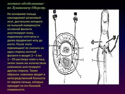 Анестезия по лукашевичу оберсту