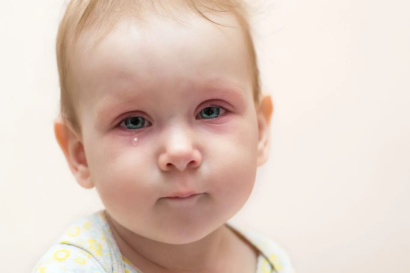 Слезотечение при простуде. Запавшие глаза у ребенка. Конъюнктивит у детей новорожденных. Конъюнктивит у грудничка.