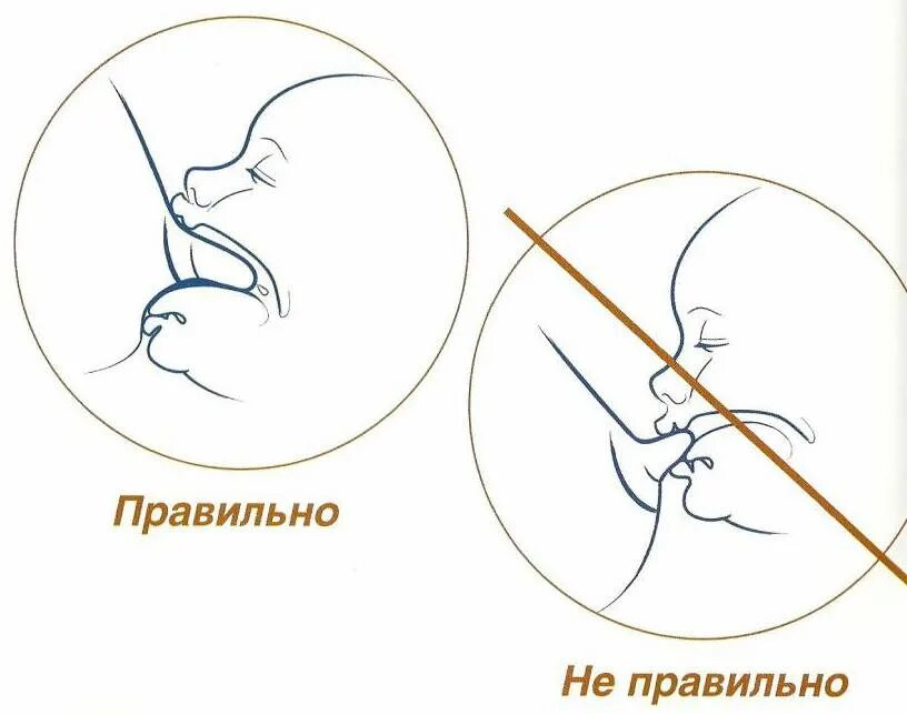 Трещины при вскармливании