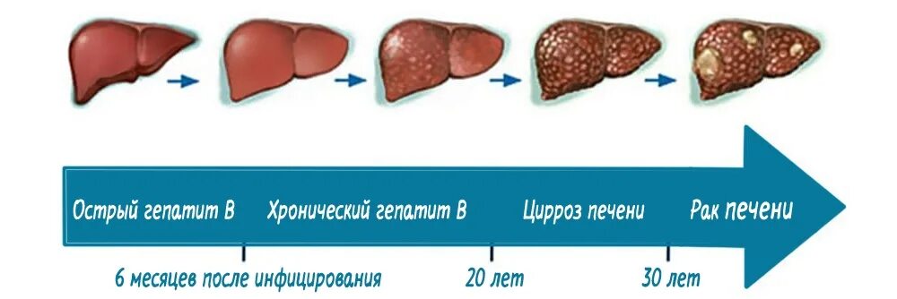 Вылечивается ли гепатит с полностью. Стадии поражения цирроза печени. заболевания печени острые и хронические гепатиты циррозы печени. хронический гепатит б цирроз печени. цирроз печени стадии гепатит с.