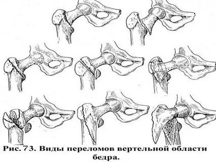 Вертельный перелом
