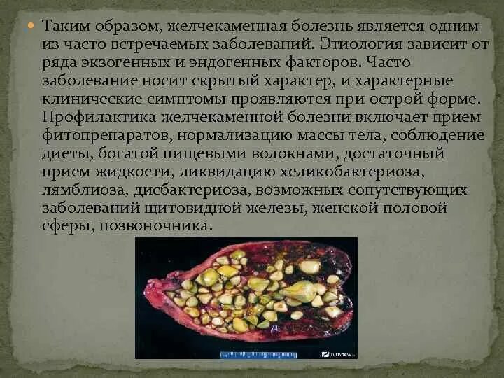 Жкб отзывы. Желчекаменная болезнь проявляется. Желчекаменная болезнь этиопатогенез. Желчекаменная болезнь симптомы. Симптомы желчекаменной болезни.