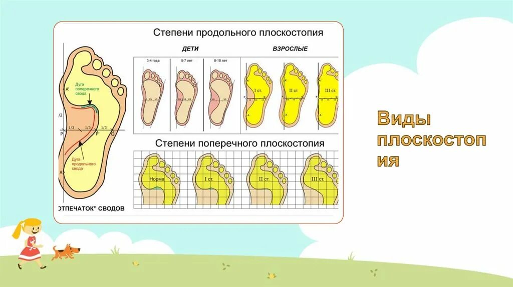 Плоскостопие 3 степени сколько градусов. Таблица плоскостопия. Последняя стадия плоскостопия. Максимальная степень плоскостопия.