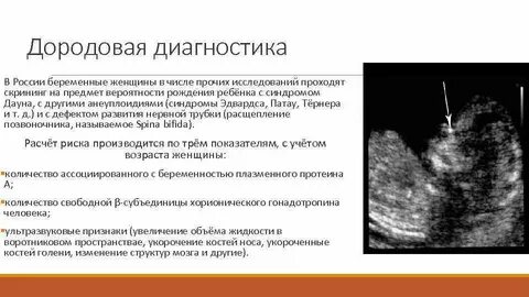 На каком сроке определяют дауна
